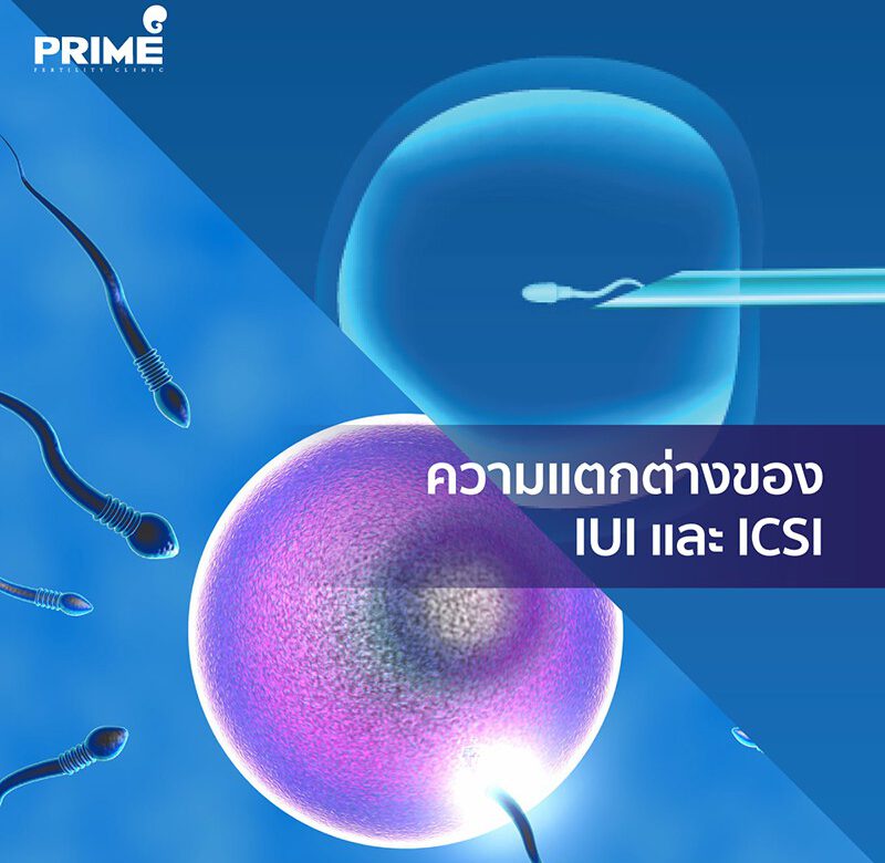 IUI ICSI，单精子注射，宫腔内受精