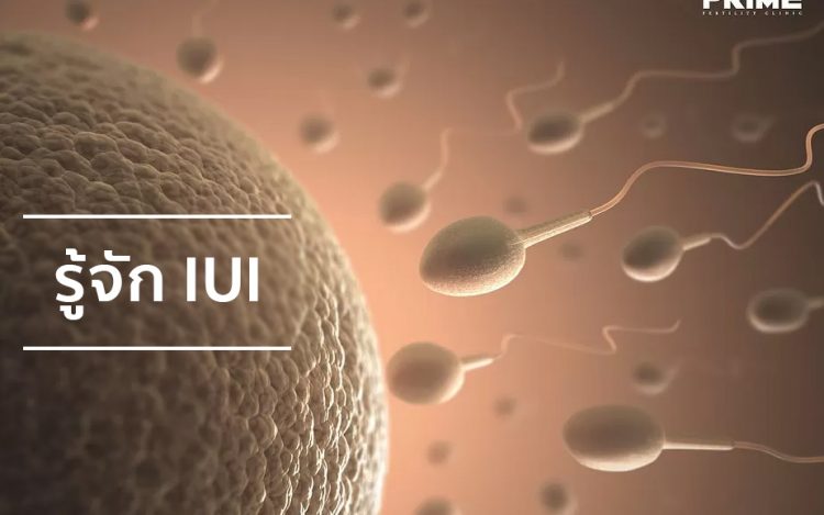 IUI,胞浆内单精子注射,ฉีดเชื้อผสมเทียม