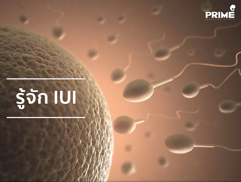 IUI,胞浆内单精子注射,ฉีดเชื้อผสมเทียม