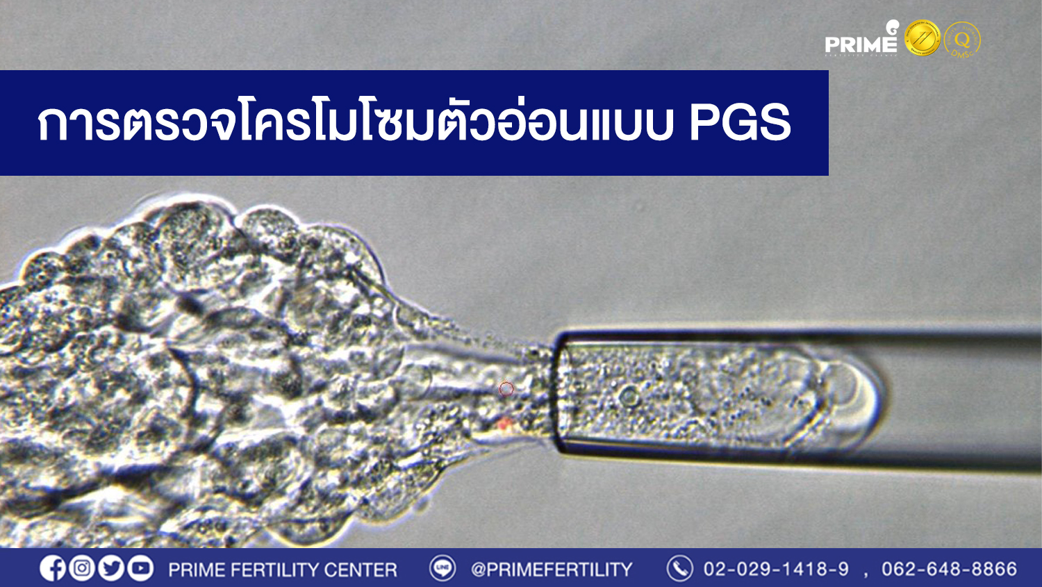 การตรวจโครโมโซมตัวอ่อนแบบ PGS