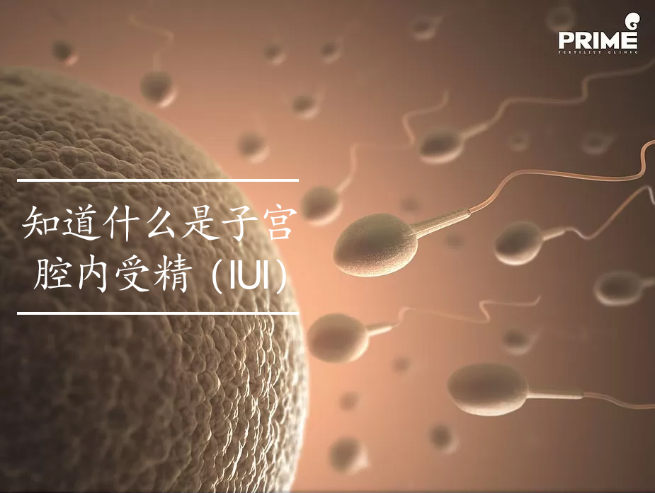 IUI,胞浆内单精子注射,ฉีดเชื้อผสมเทียม