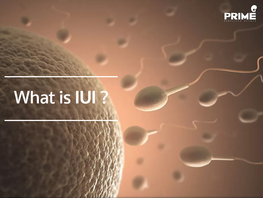 IUI,胞浆内单精子注射,ฉีดเชื้อผสมเทียม