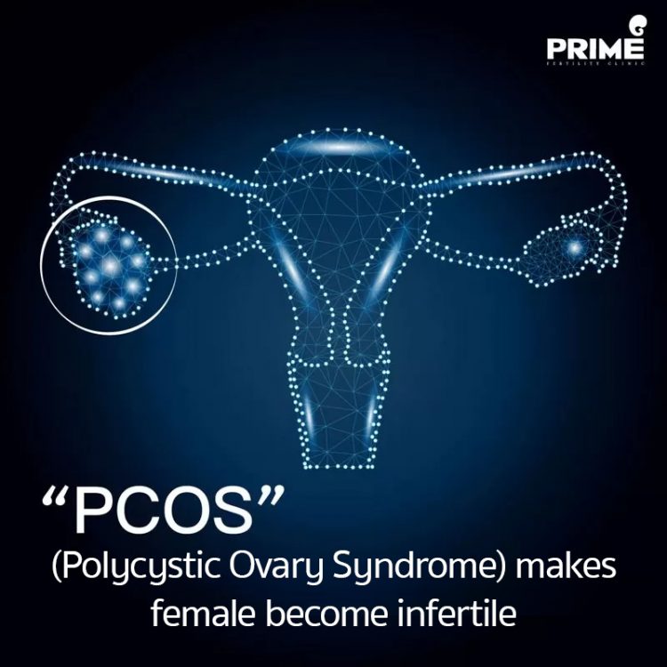 PCOS Polycystic Ovary Syndrome Makes Female Become Infertile ICSI