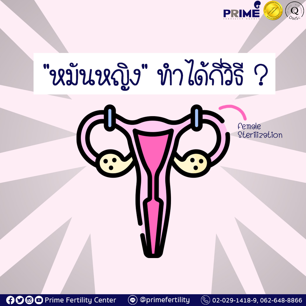 หมันหญิงทำได้กี่วิธี