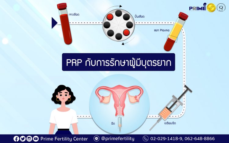 PRP Treatment and Infertility,PRP กับเรื่องมีบุตรยาก,高浓度血小板血浆 (PRP) 与不孕不育症