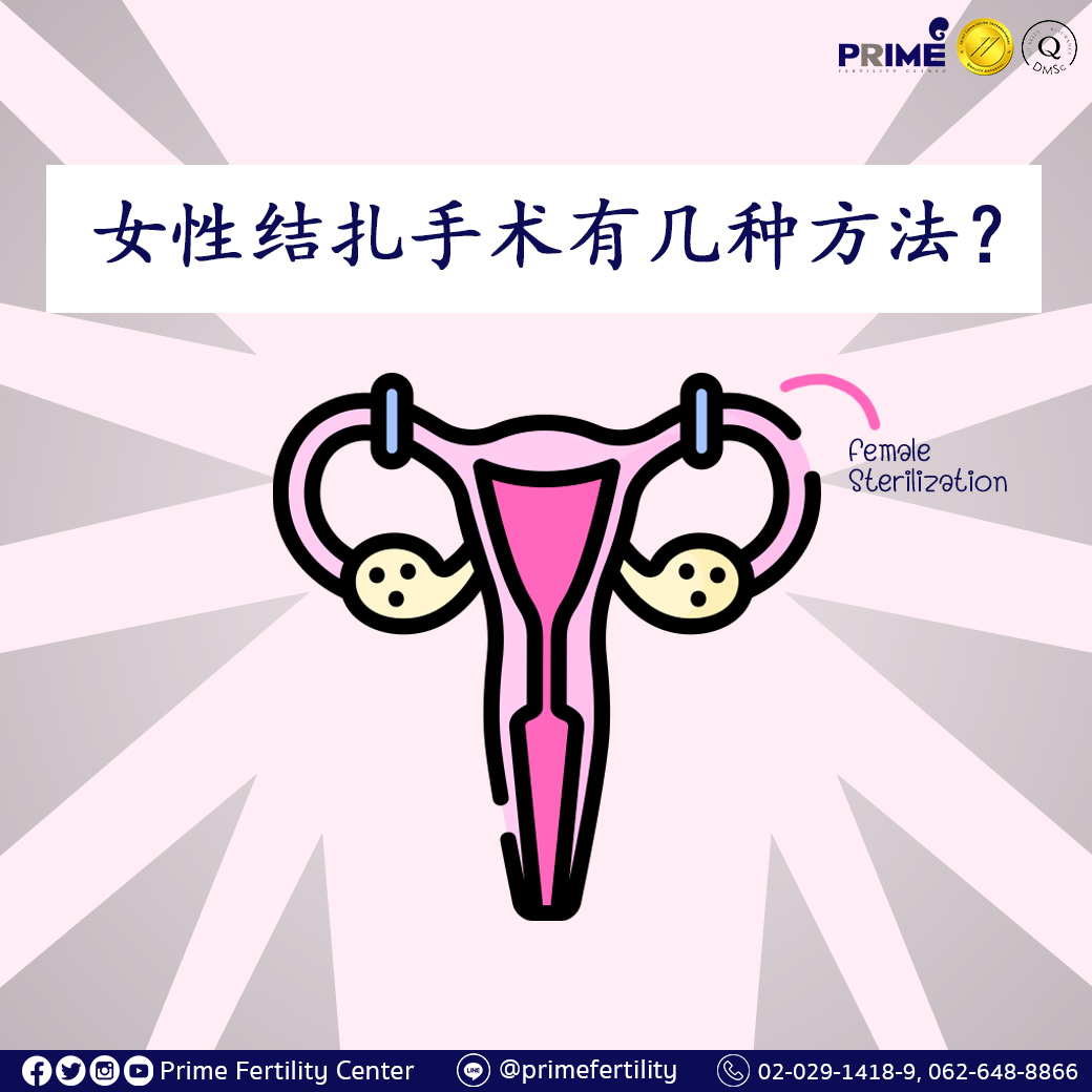 หมันหญิงทำได้กี่วิธี Chi