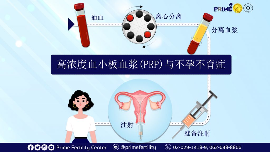 PRP Treatment and Infertility,PRP กับเรื่องมีบุตรยาก,高浓度血小板血浆 (PRP) 与不孕不育症