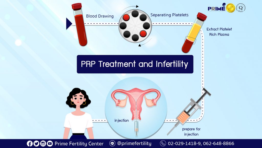 PRP Treatment and Infertility,PRP กับเรื่องมีบุตรยาก,高浓度血小板血浆 (PRP) 与不孕不育症