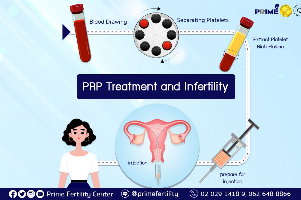 PRP Treatment and Infertility,PRP กับเรื่องมีบุตรยาก,高浓度血小板血浆 (PRP) 与不孕不育症