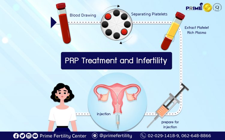 PRP Treatment and Infertility,PRP กับเรื่องมีบุตรยาก,高浓度血小板血浆 (PRP) 与不孕不育症