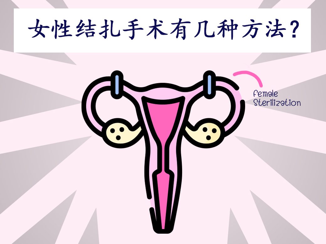 female sterilization, หมันหญิง,女性结扎