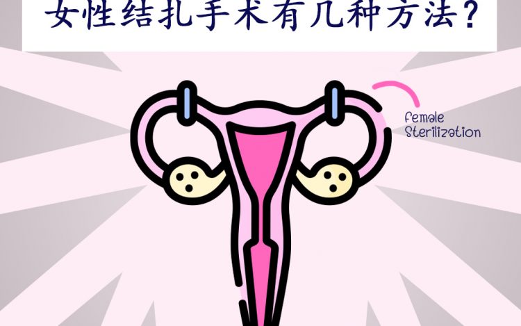 female sterilization, หมันหญิง,女性结扎