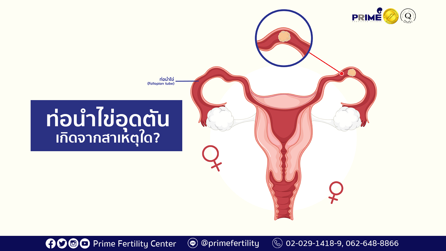 ท่อนำไข่อุดตัน