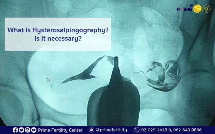 What is Hysterosalpingography? Is it necessary?