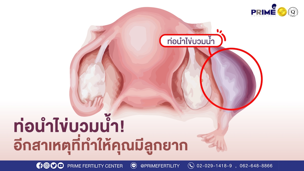 ท่อนำไข่บวมน้ำ ขึ้นเว็บ