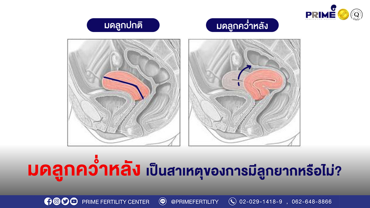 มดลูกคว่ำหลัง ขึ้นเว็บ