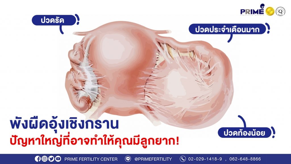 พังผืดอุ้งเชิงกราน ขึ้นเว็บ