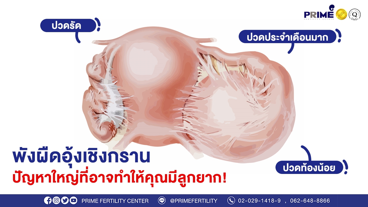 พังผืดอุ้งเชิงกราน ขึ้นเว็บ
