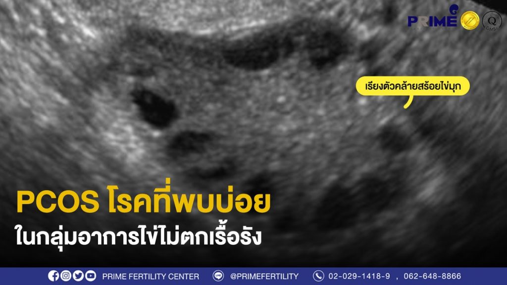 ไข่ไม่ตกเรื้อรัง เว็บ