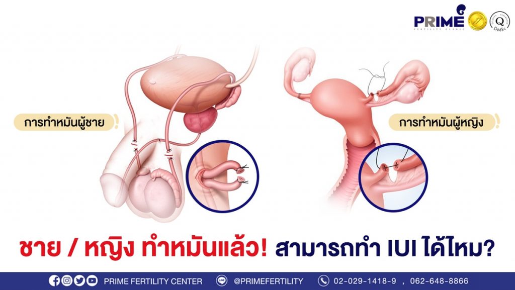 ชาย หญิง ทำหมันแล้ว ขึ้นเว็บ