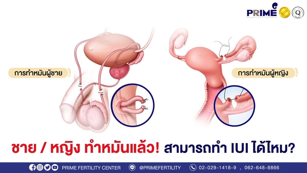 ชาย หญิง ทำหมันแล้ว ขึ้นเว็บ