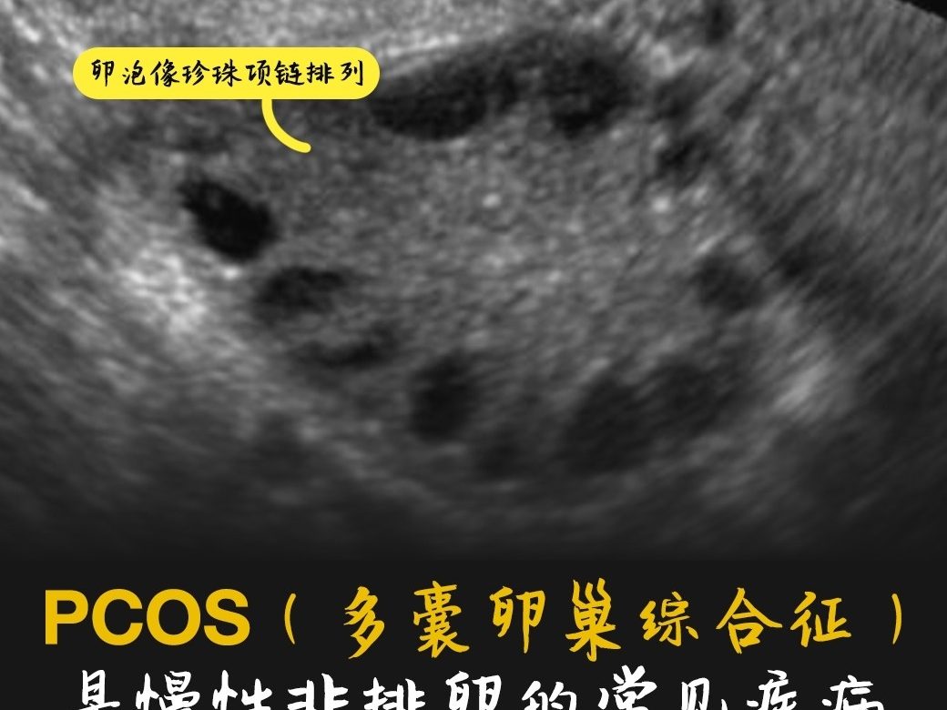 PCOS是慢性非卵巢综合征的常见病
