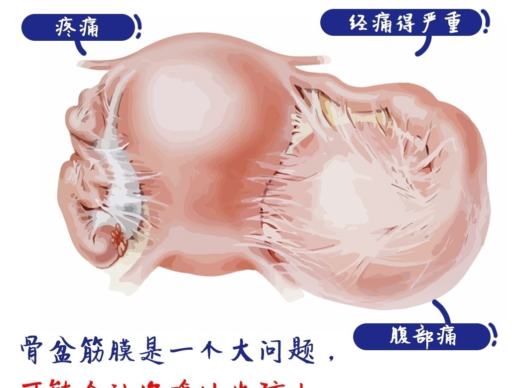 骨盆筋膜是一个大问题，可能会让你难以生育！