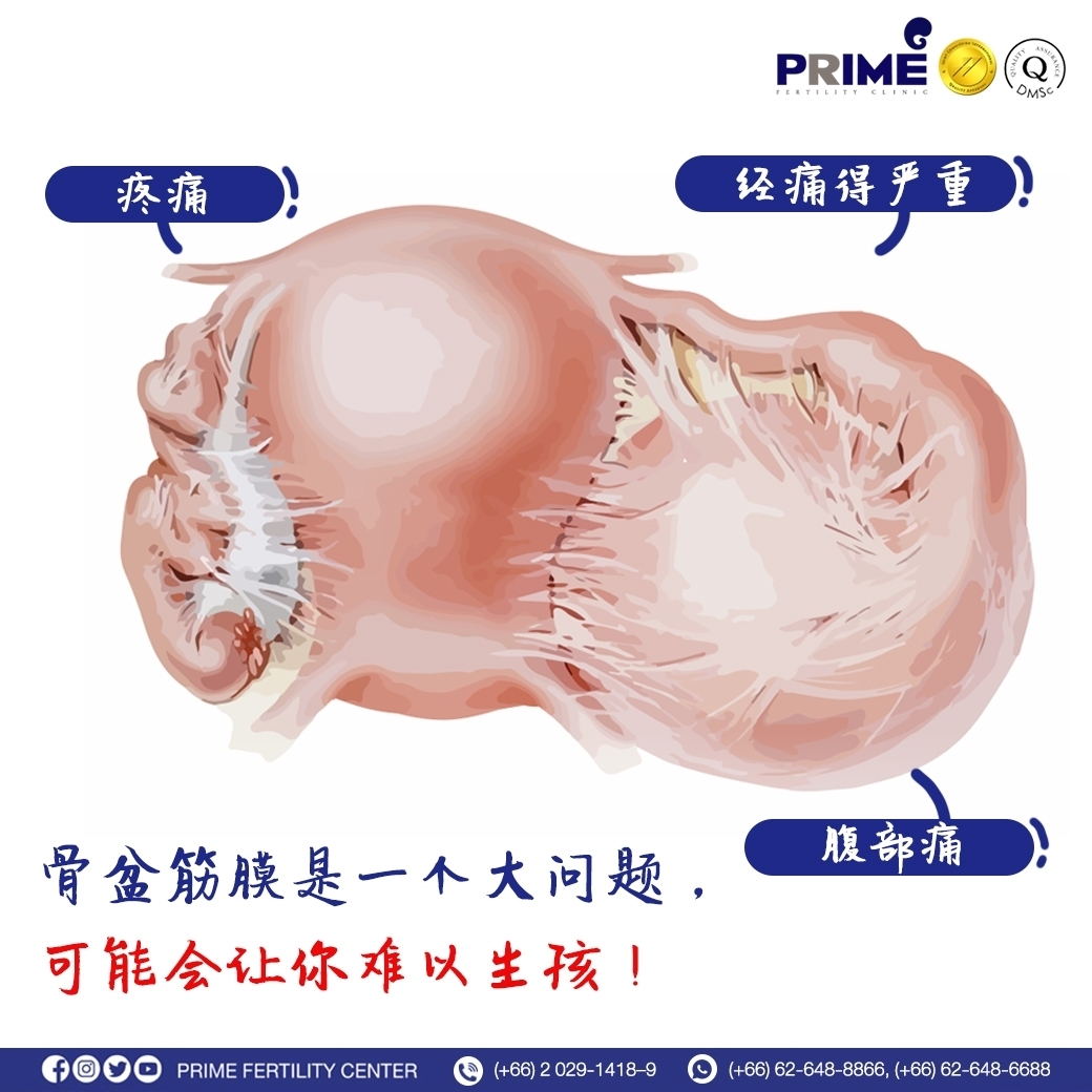 骨盆筋膜是一个大问题，可能会让你难以生育！