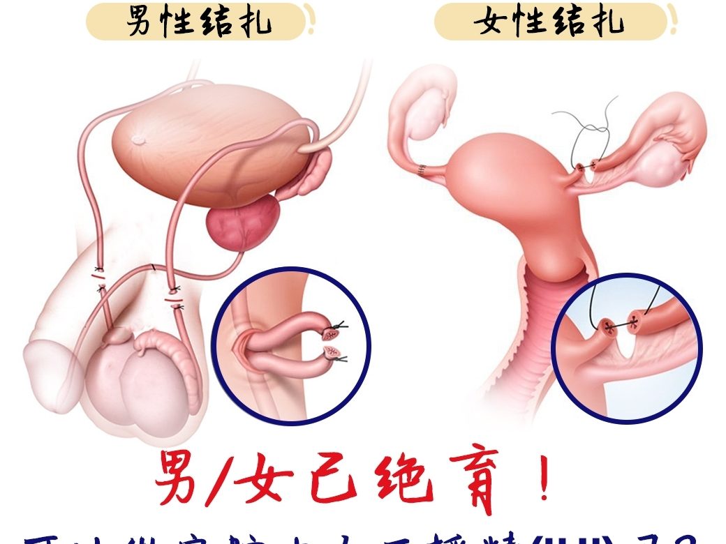 男/女已绝育！可以做宫腔内人工授精吗❓