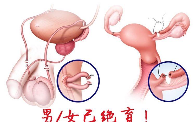 男/女已绝育！可以做宫腔内人工授精吗❓