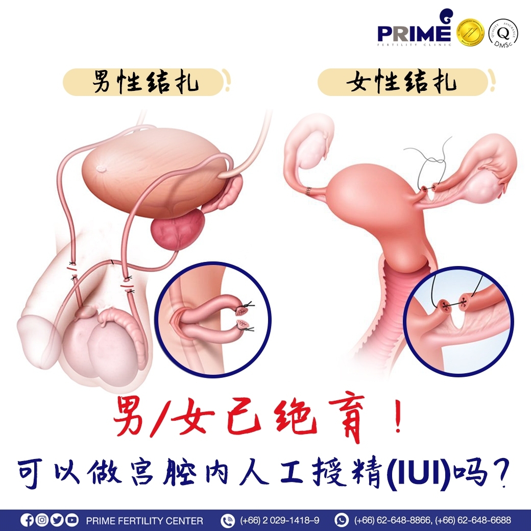 男/女已绝育！可以做宫腔内人工授精吗❓