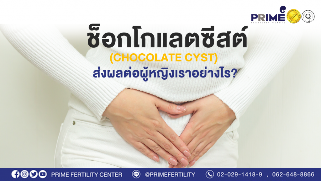 ช็อกโกแลตซีสต์ Chocolate Cyst web