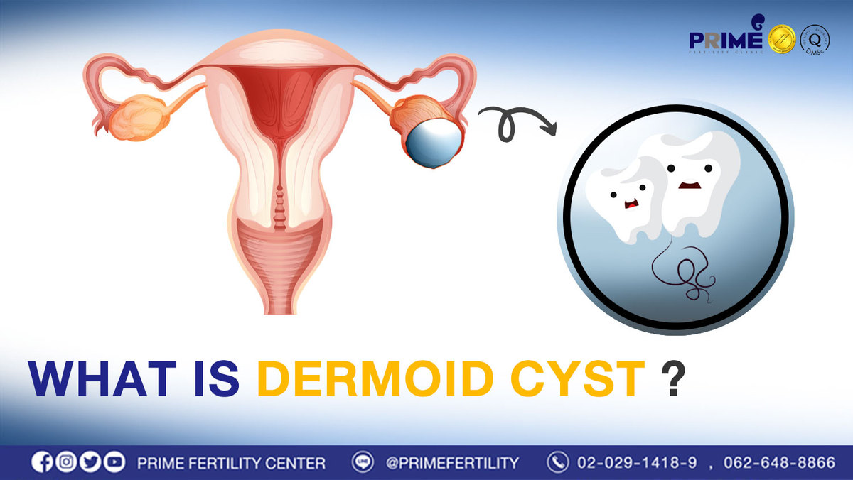 bangkok ivf | What is Dermoid Cyst? | fertility clinic bangkok | ICSI