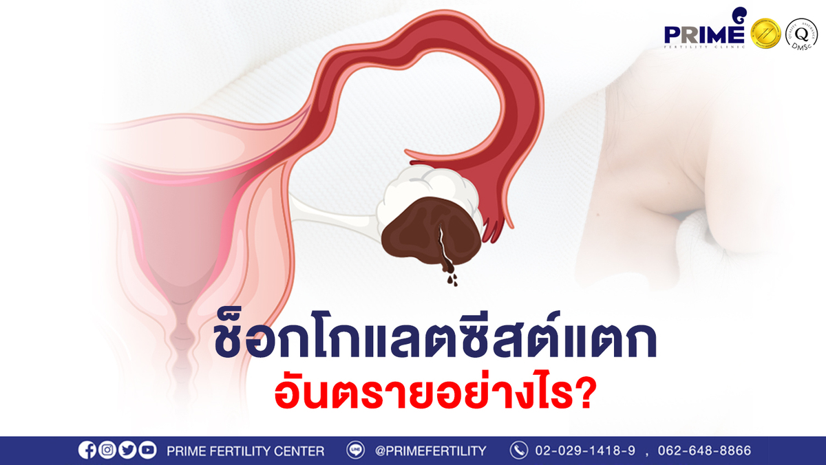 ช็อกโกแลตซีสต์แตก อันตรายอย่างไร ขึ้นเว็ป1