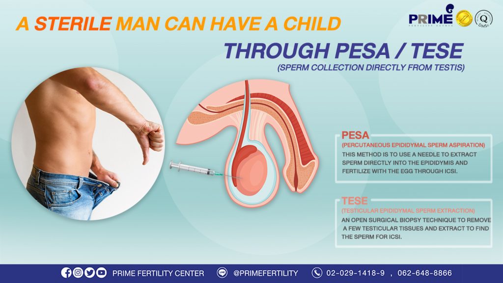 A sterile man can have a child through PESA / TESE. - เป็นหมันมีลูกได้ เวป เป็นหมันมีลูกได้ เวป