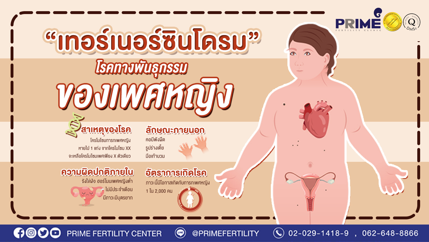 เทอร์เนอร์ซินโดรม (Turner Syndrome) โรคทางพันธุกรรมของเพศหญิง