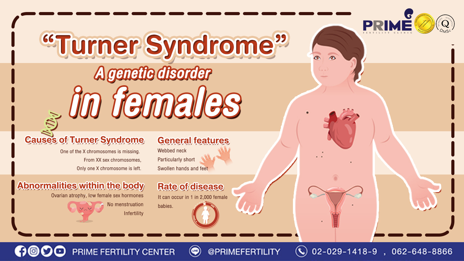 Turner Syndrome: A genetic disorder in females