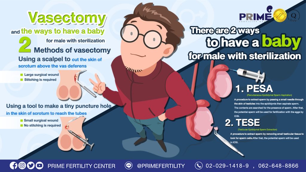 How many ways of male sterilization? What are the ways to have a baby for male with sterilization? - info ทำหมันชาย อยากมีลูก web info ทำหมันชาย อยากมีลูก web