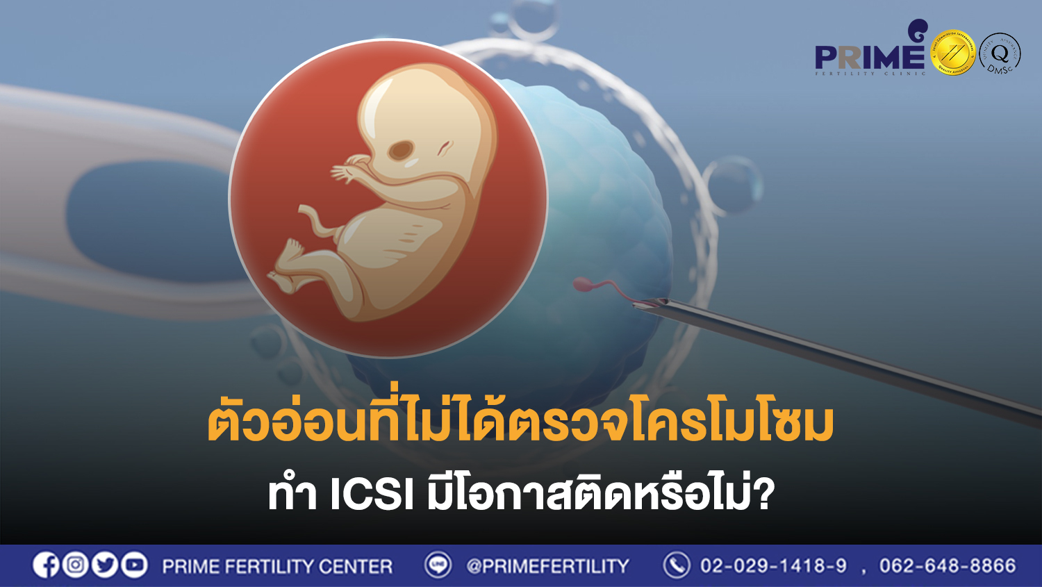 ตัวอ่อนที่ไม่ได้ตรวจโครโมโซม ทำ ICSI มีโอกาสติดหรือไม่?