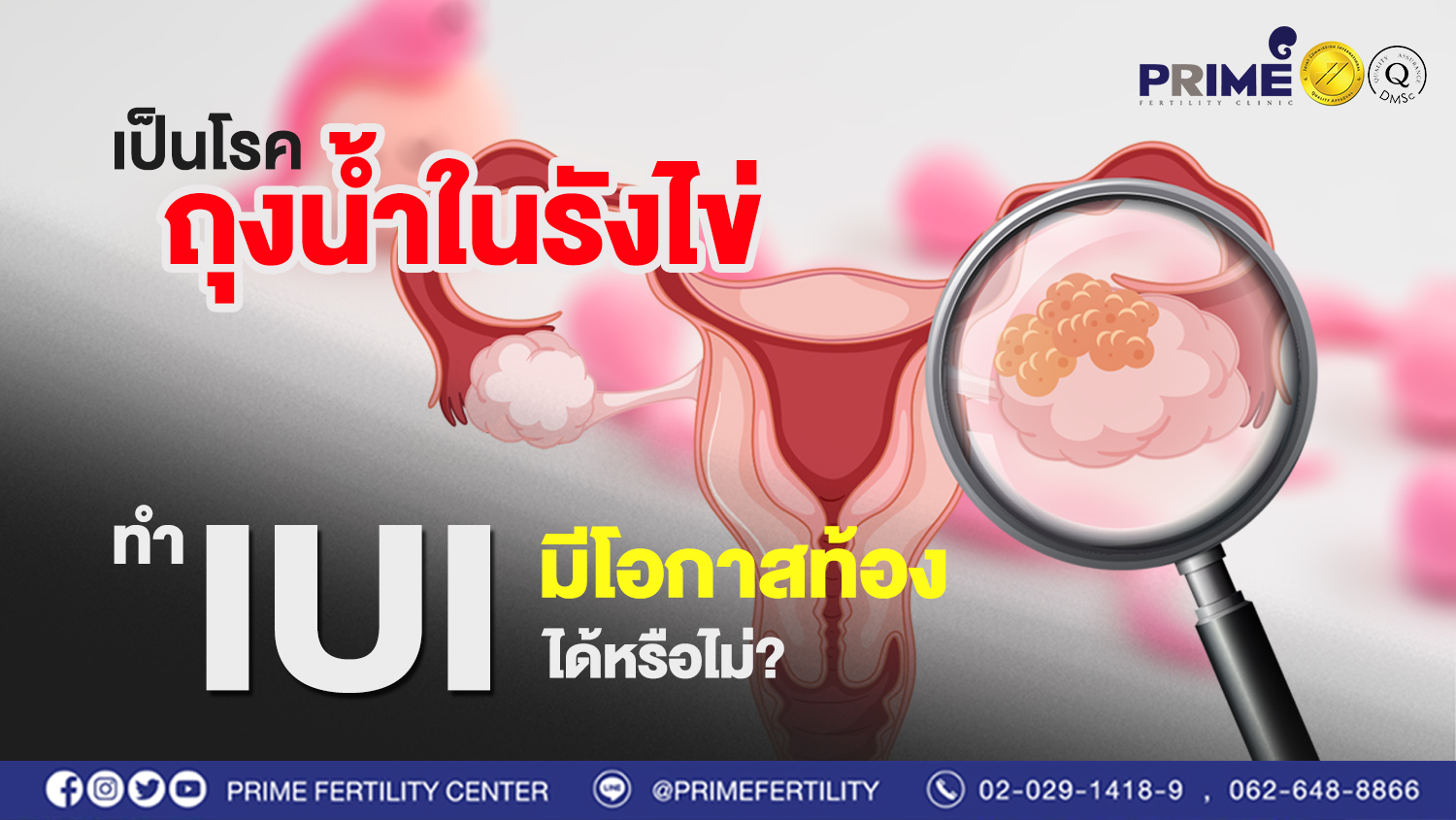 เป็น “โรคถุงน้ำในรังไข่” ทำ IUI แล้วมีโอกาสท้องได้หรือไม่?