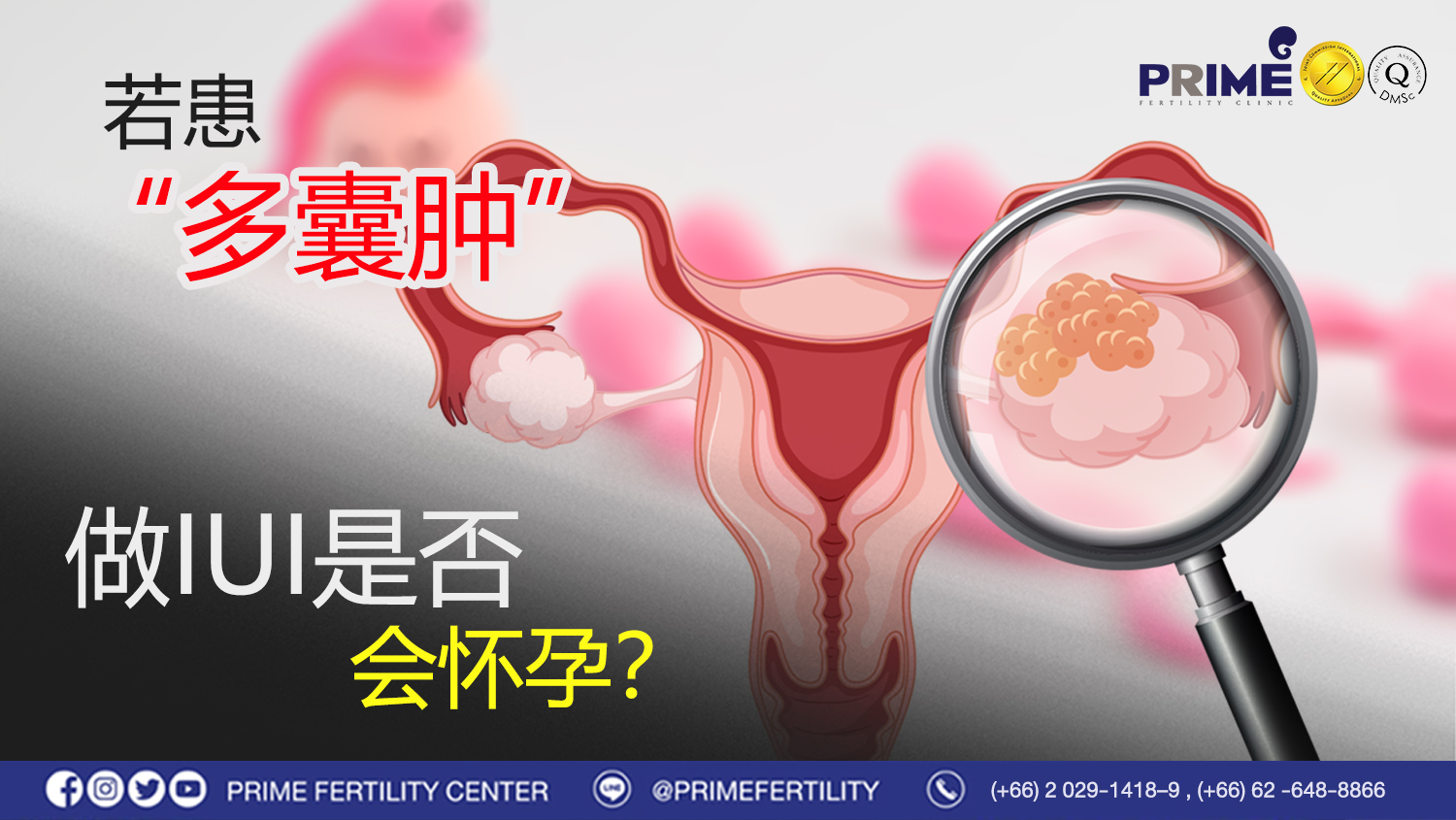 患多囊肿做IUI会怀孕吗? - เป็นโรคถุงน้ำในรังไข่ ทำ IUI แล้วมีโอกาสท้องได้หรือไม่ web เป็นโรคถุงน้ำในรังไข่ ทำ IUI แล้วมีโอกาสท้องได้หรือไม่ web