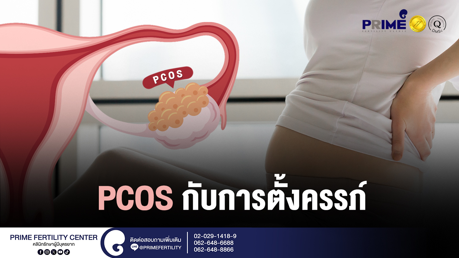 PCOS กับการตั้งครรภ์ web