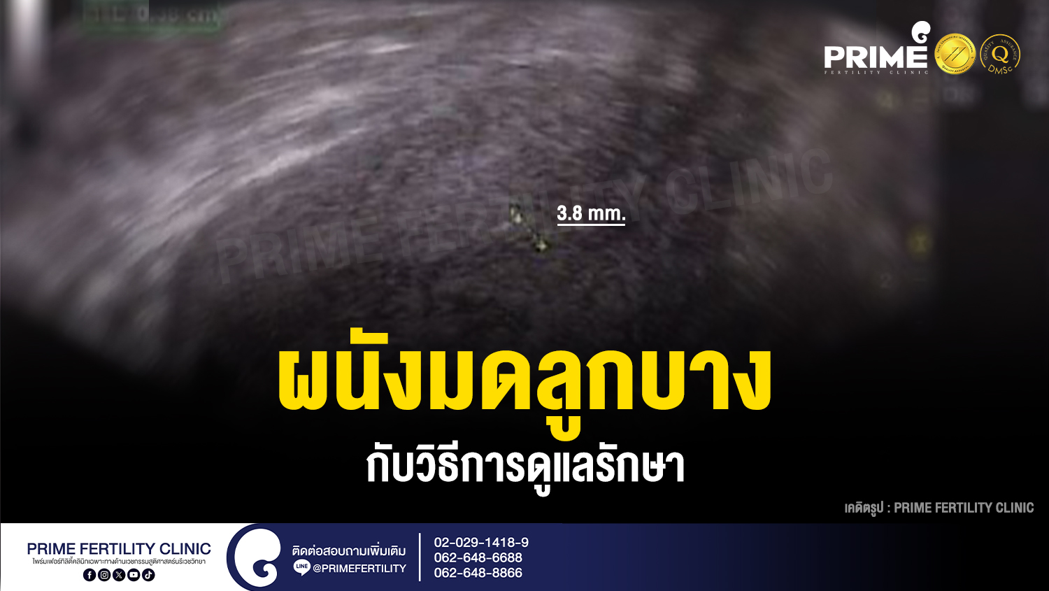 ผนังมดลูกบาง กับวิธีการดูแลรักษา - ผนังมดลูกบาง กับวิธีการดูแลรักษา web ผนังมดลูกบาง กับวิธีการดูแลรักษา web