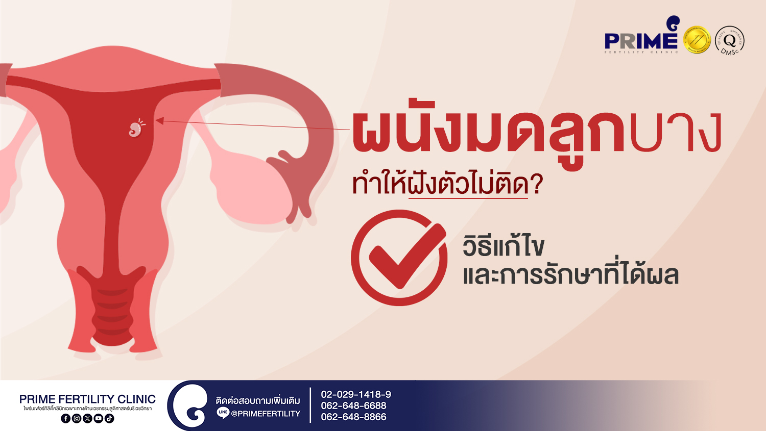 ผนังมดลูกบางทำให้ฝังตัวไม่ติด? วิธีแก้ไขและการรักษาที่ได้ผล - SEO ผนังมดลูกบางทำให้ฝังตัวไม่ติด วิธีแก้ไขและการรักษาที่ได้ผล web SEO ผนังมดลูกบางทำให้ฝังตัวไม่ติด วิธีแก้ไขและการรักษาที่ได้ผล web
