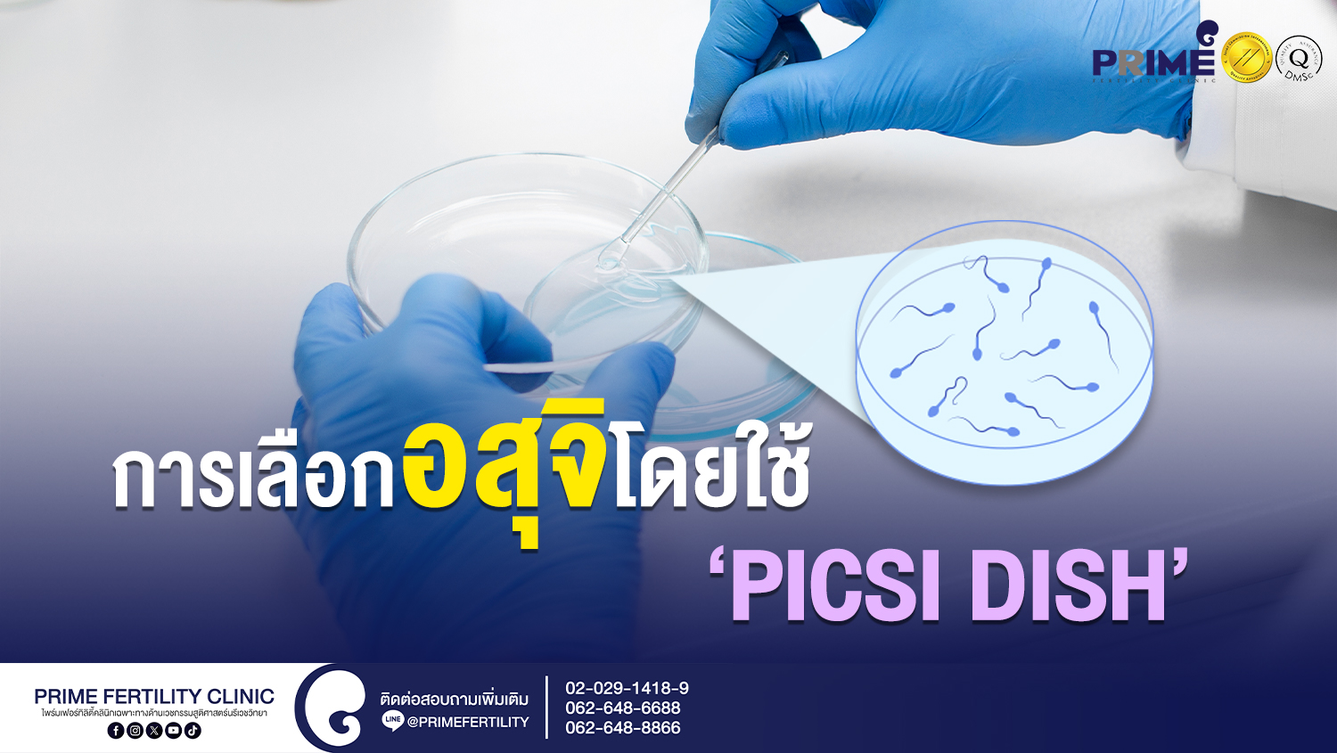 การเลือกอสุจิโดยใช้ PICSI DISH - การเลือกอสุจิโดยใช้ PICSI DISH เว็ป การเลือกอสุจิโดยใช้ PICSI DISH เว็ป