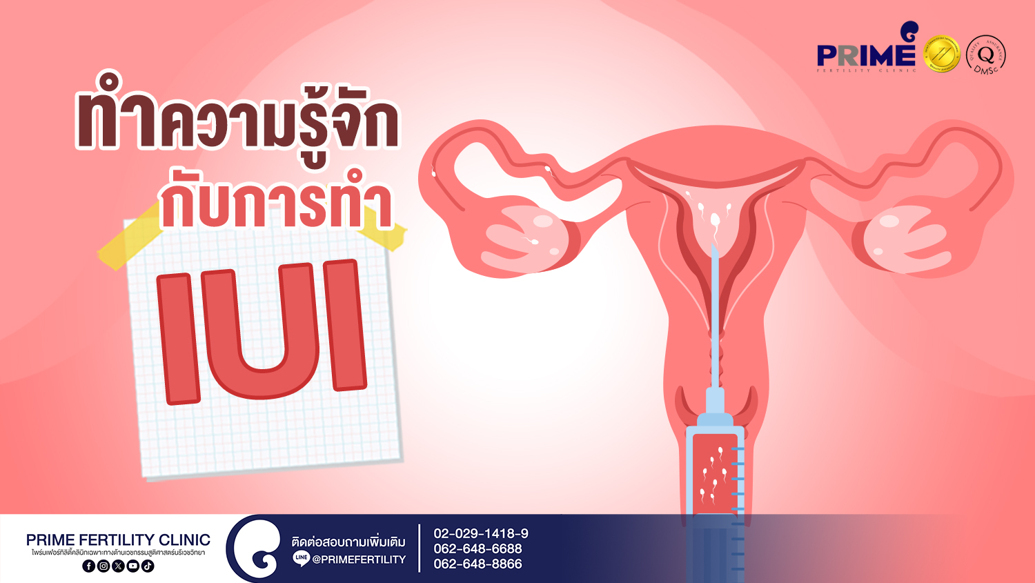 ทำความรู้จักกับการทำ IUI - มาทำความรู้จักกับการทำ IUI Web รู้จักการทำ IUI