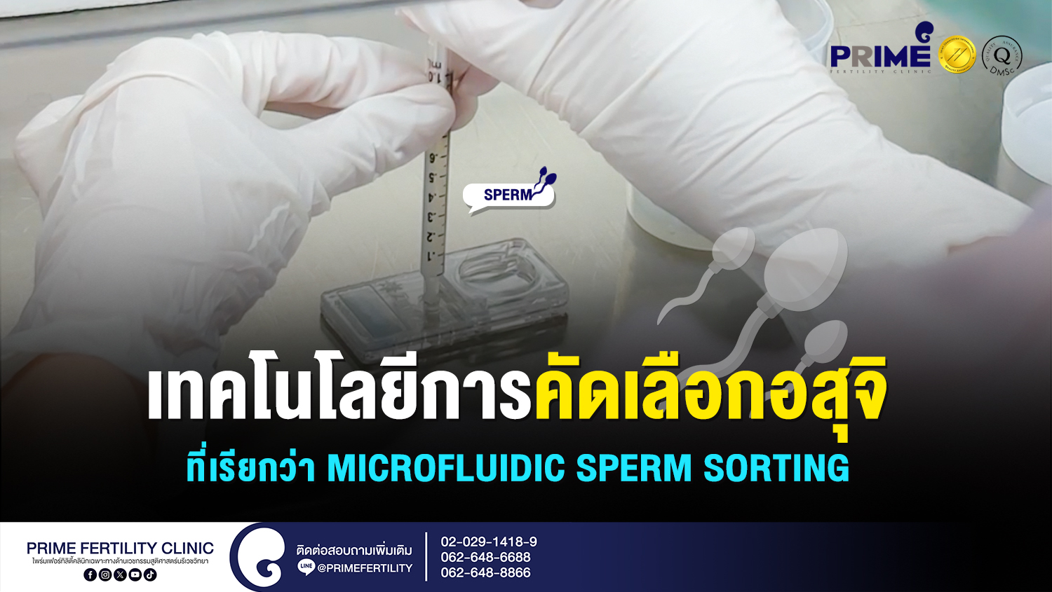 เทคโนโลยีการคัดเลือกอสุจิ ที่เรียกว่า "Microfluidic Sperm Sorting" - เทคโนโลยีการคัดเลือกอสุจิ ที่เรียกว่า Microfluidic Sperm Sorting web เทคโนโลยีการคัดเลือกอสุจิ ที่เรียกว่า Microfluidic Sperm Sorting web