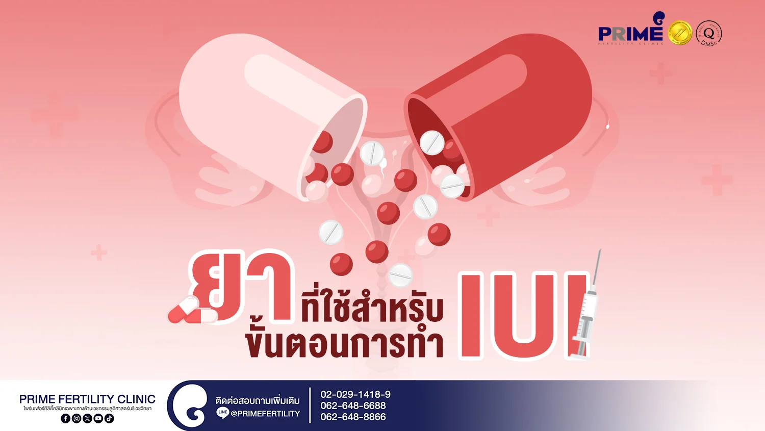 ยาที่ใช้สำหรับขั้นตอนการทำ IUI - ยาที่ใช้สำหรับขั้นตอนการทำ IUI Web ยาที่ใช้สำหรับขั้นตอนการทำ IUI Web